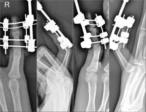 Innovative Techniques for Healing Complex Finger Fractures and Joint Injuries"