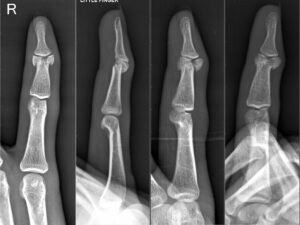 Innovative Techniques for Healing Complex Finger Fractures and Joint Injuries"