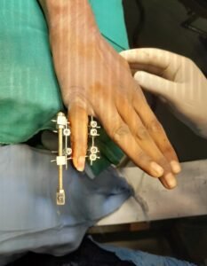 Innovative Techniques for Healing Complex Finger Fractures and Joint Injuries"