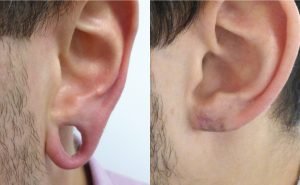 Ear and Body Piercing Services at Healing Touch Hospital dehradun